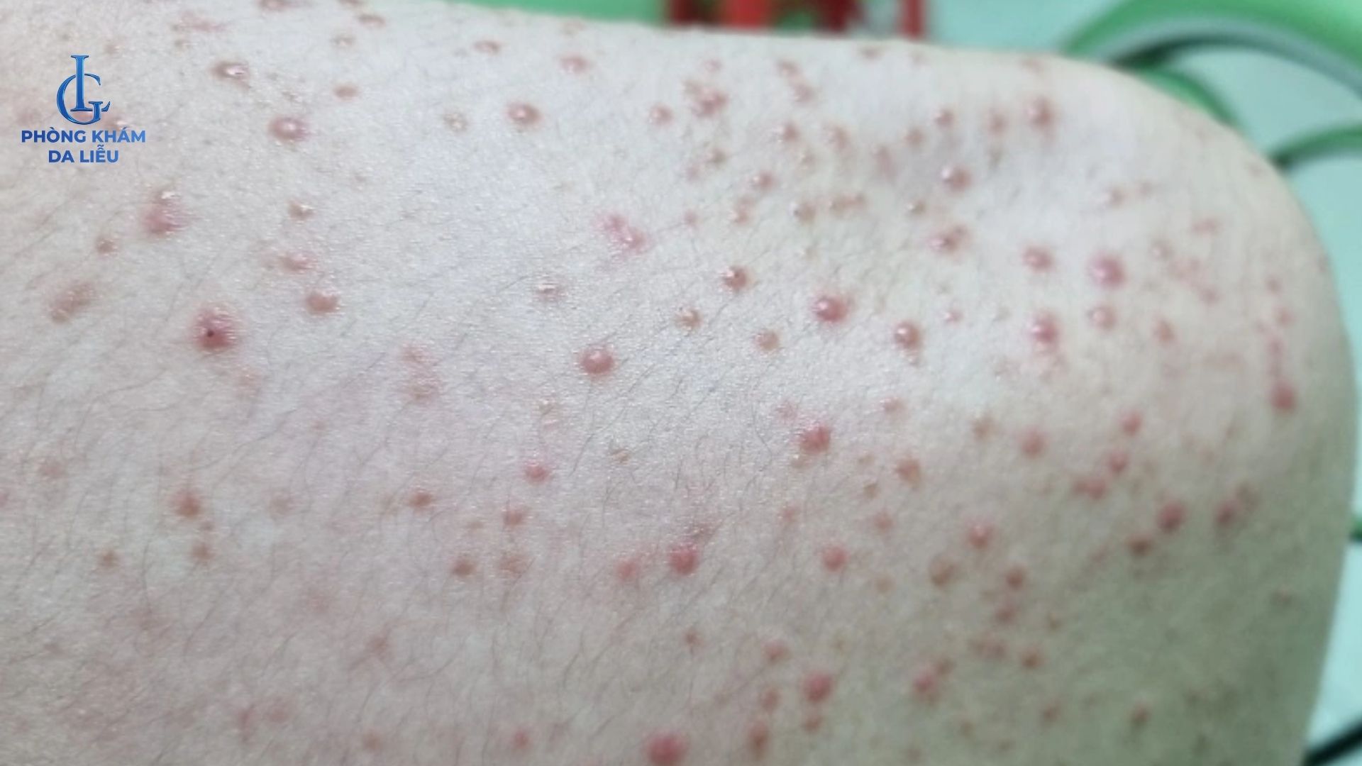 nguyên nhân mụn trứng cá ở lưng