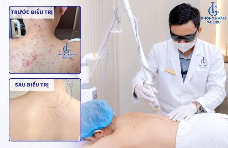 điều trị mụn lưng bằng acthyderm co2