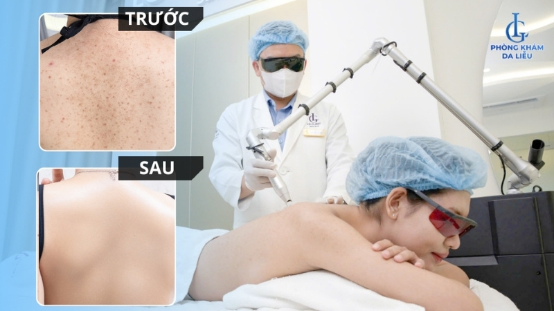 điều trị mụn lưng tại lg
