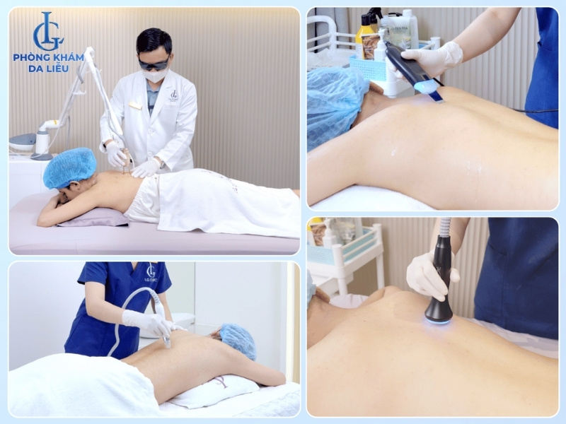 điều trị mụn lưng tại phòng khám da liễu lg