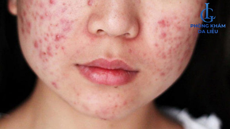 cách trị mụn trứng cá