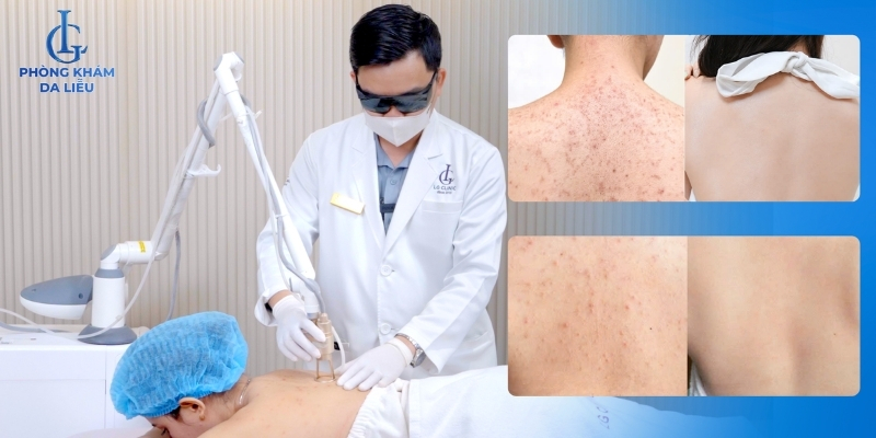 điều trị mụn trứng cá ở lưng tại phòng khám da liễu
