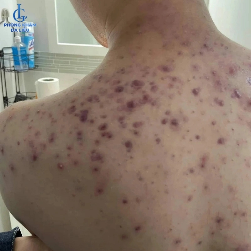 hậu quả mụn nang ở lưng