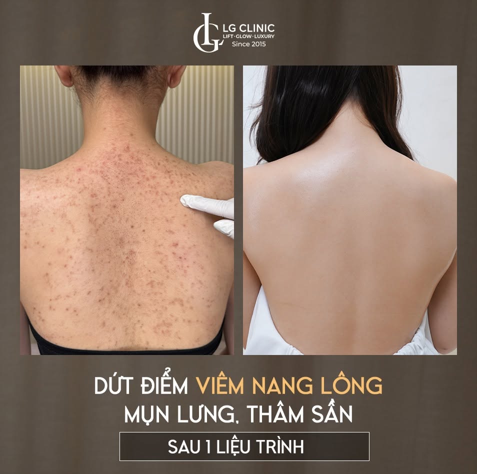 Hình ảnh trước và sau khi trị mụn trứng cá ở lưng của khách