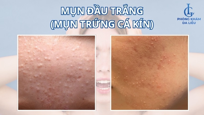 Hình ảnh mụn đầu trắng ở vùng trán và má