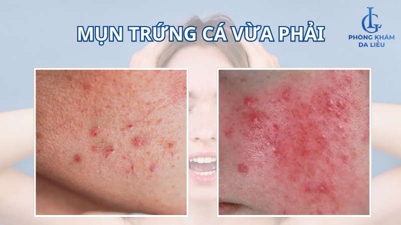 mụn trứng cá vừa phải