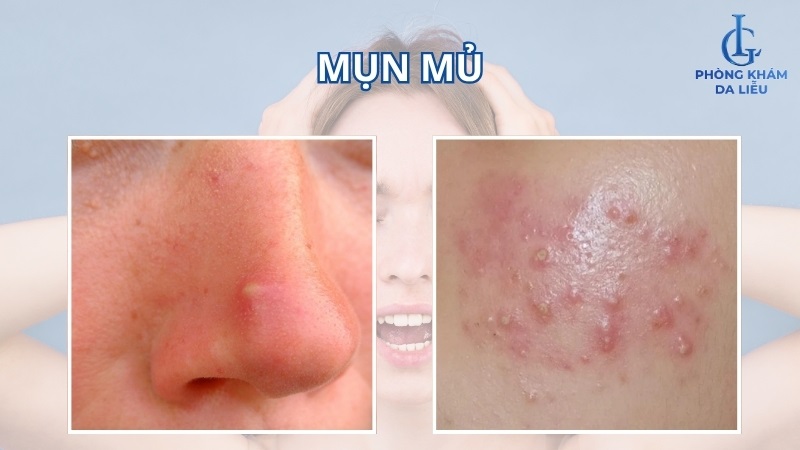 mụn mủ