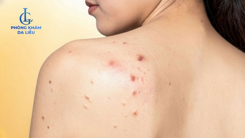 hình ảnh mụn lưng