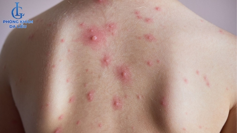 hình ảnh mụn nhọt ở lưng