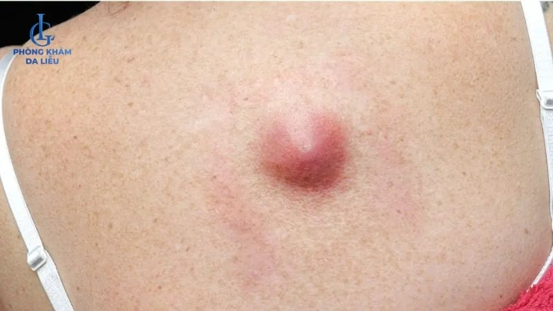 hình ảnh mụn nhọt ở vùng lưng