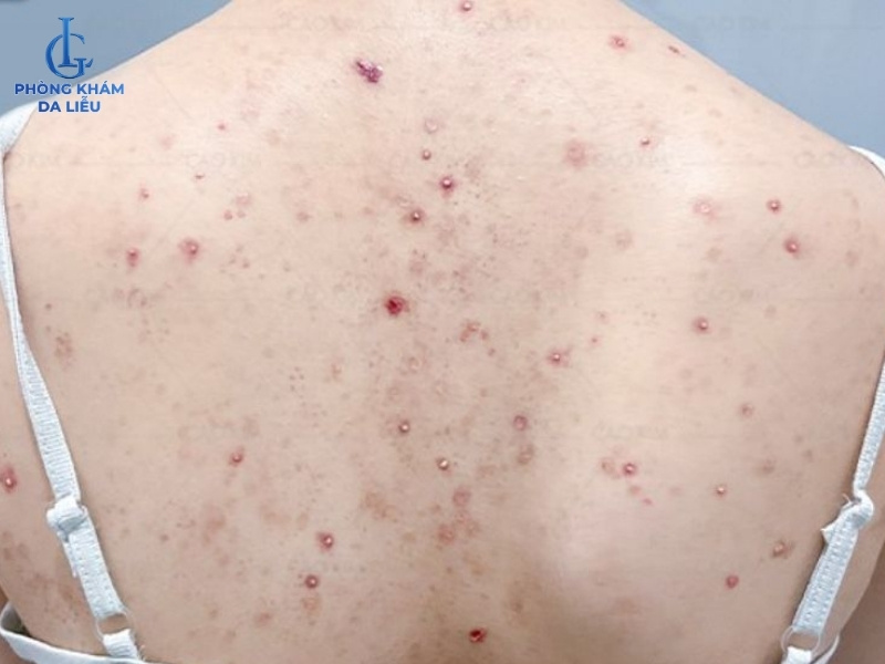 hình ảnh viêm nang lông ở lưng