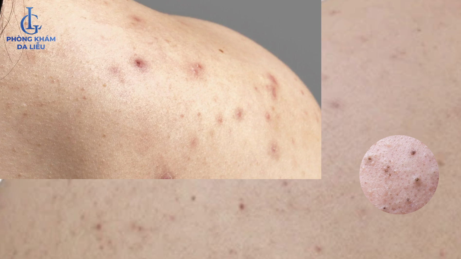 mụn đầu đen ở lưng nam