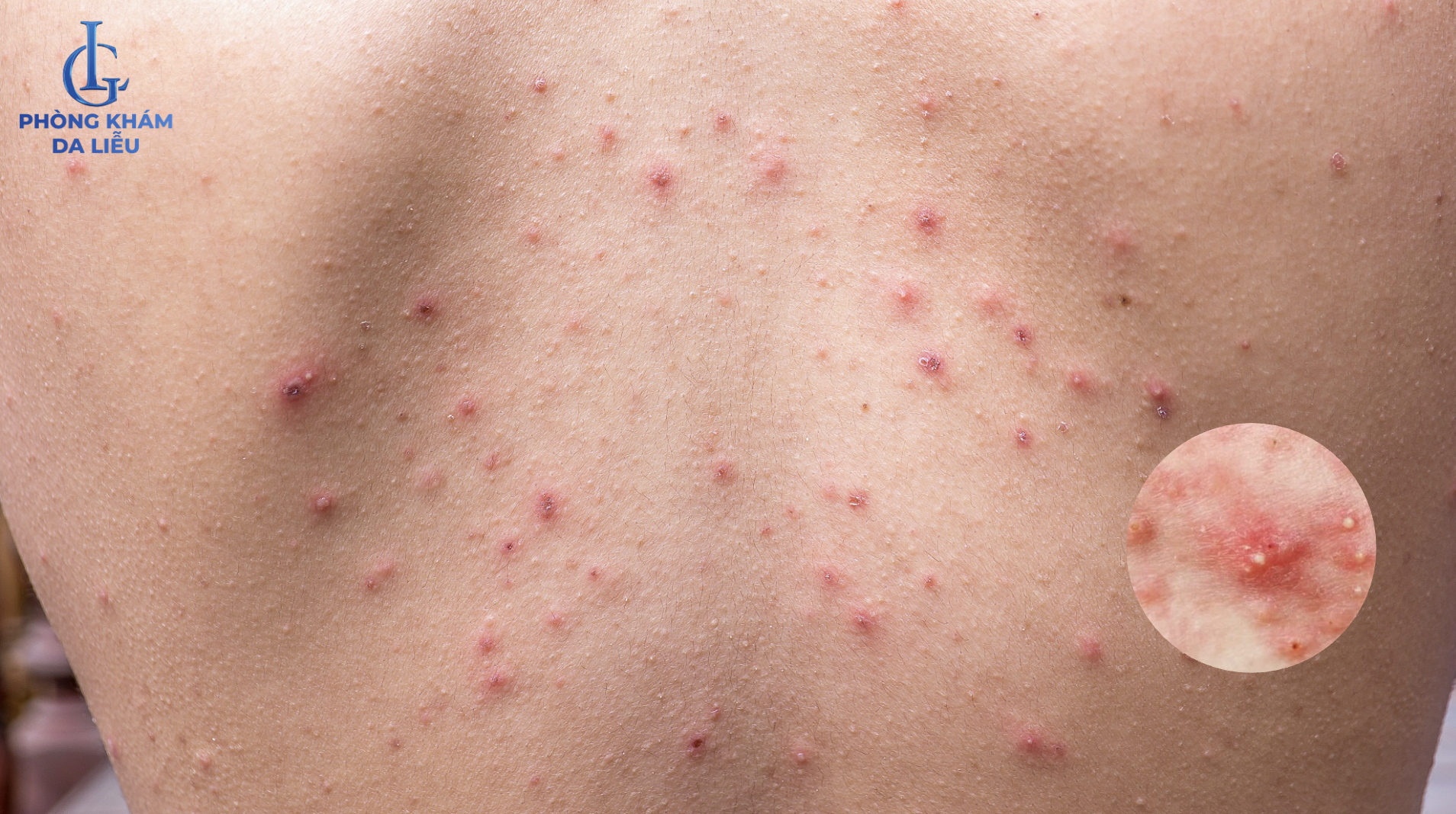 mụn mủ lưng nam