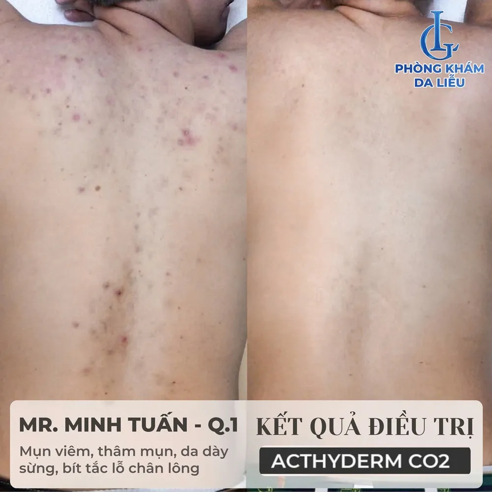 kết quả điều trị mụn lưng