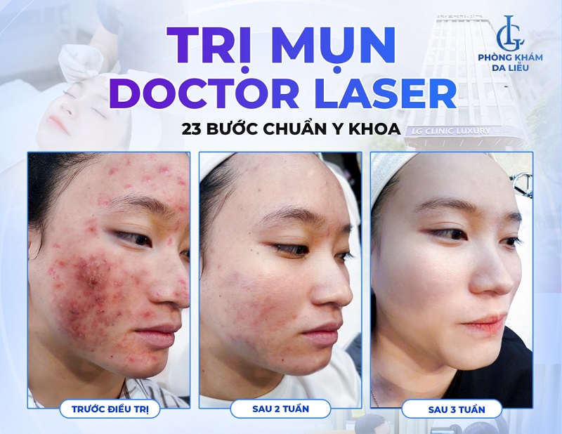 trị mụn doctor laser 23 bước tại phòng khám da liễu LG