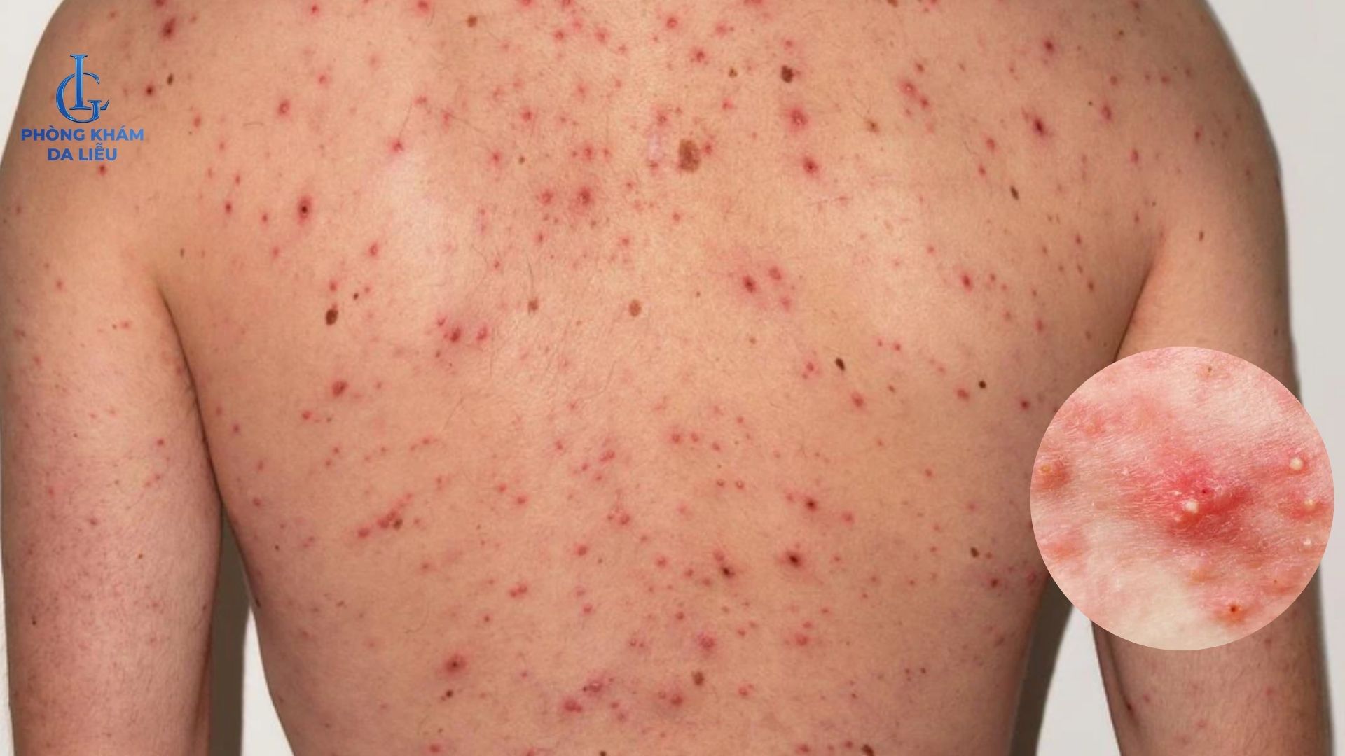 mụn bọc ở lưng
