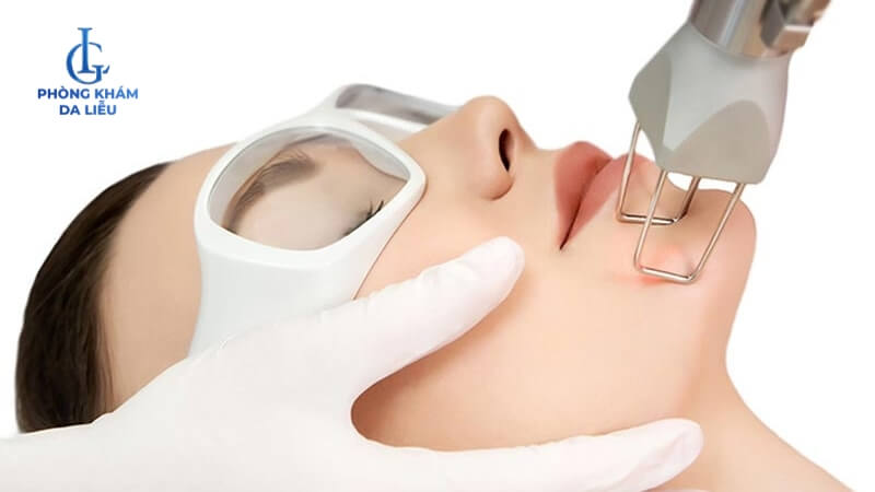 Laser CO2 trị mụn cơm