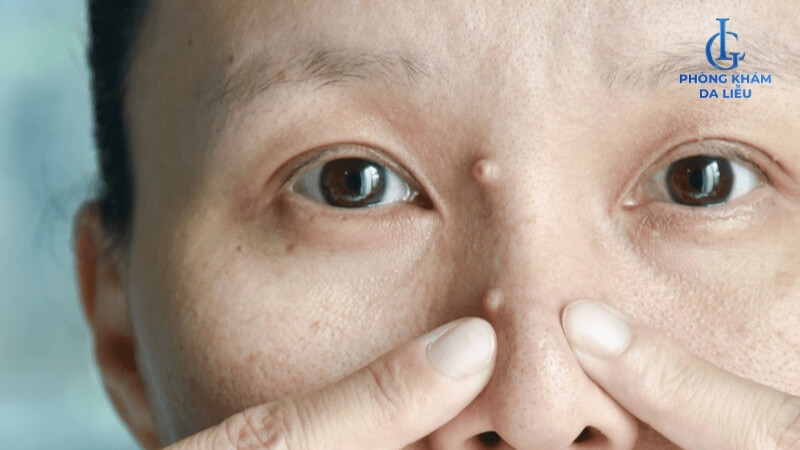 Mụn cơm ở mặt