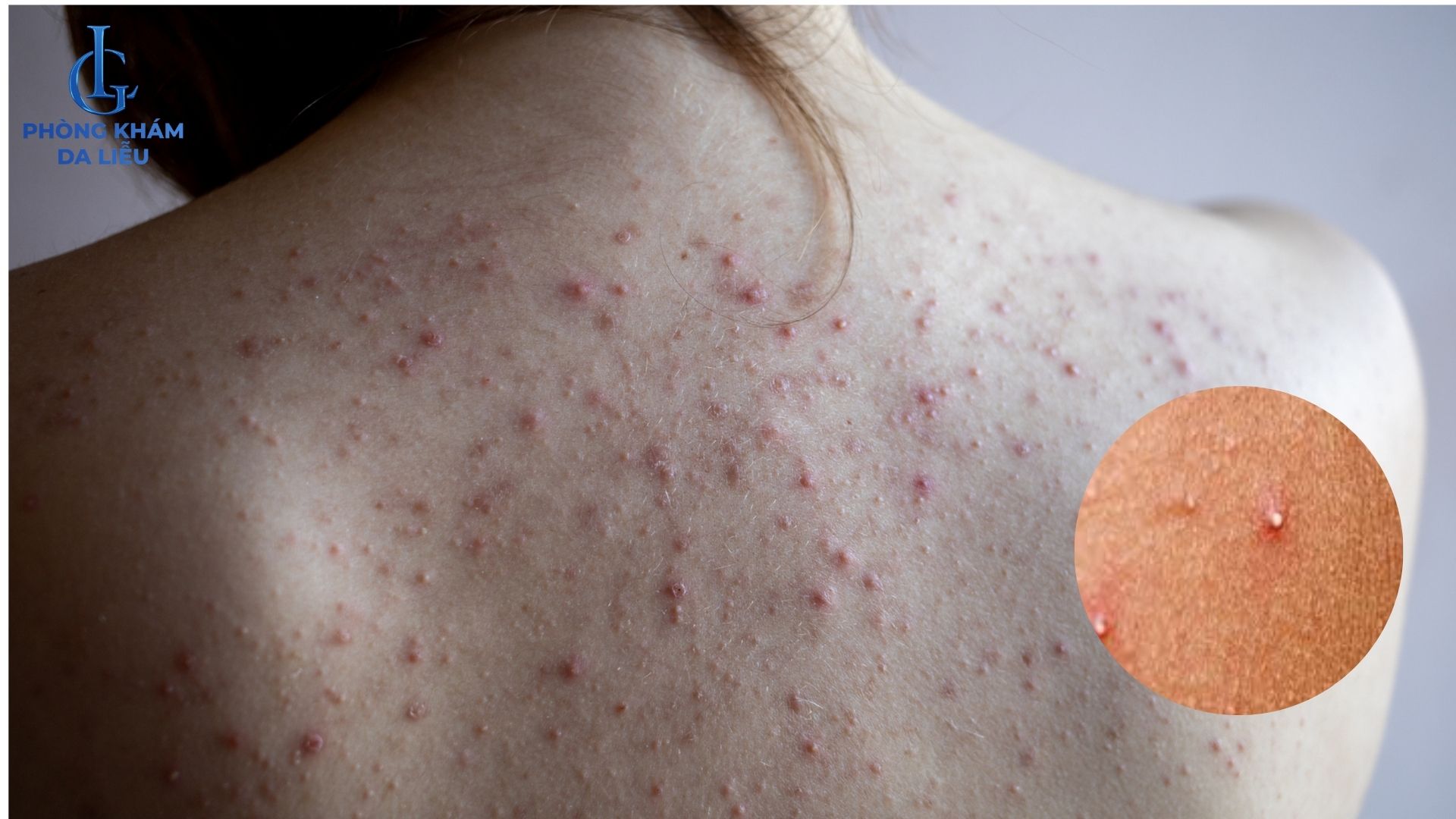 mụn đầu trắng vùng lưng