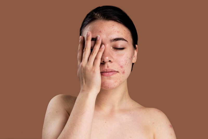 Triệu chứng của mụn do stress