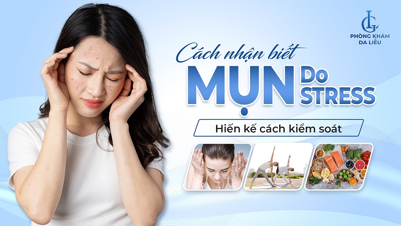 mụn do stress