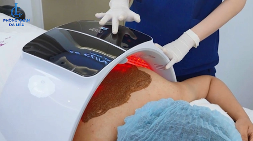 phương pháp điều trị mụn lưng