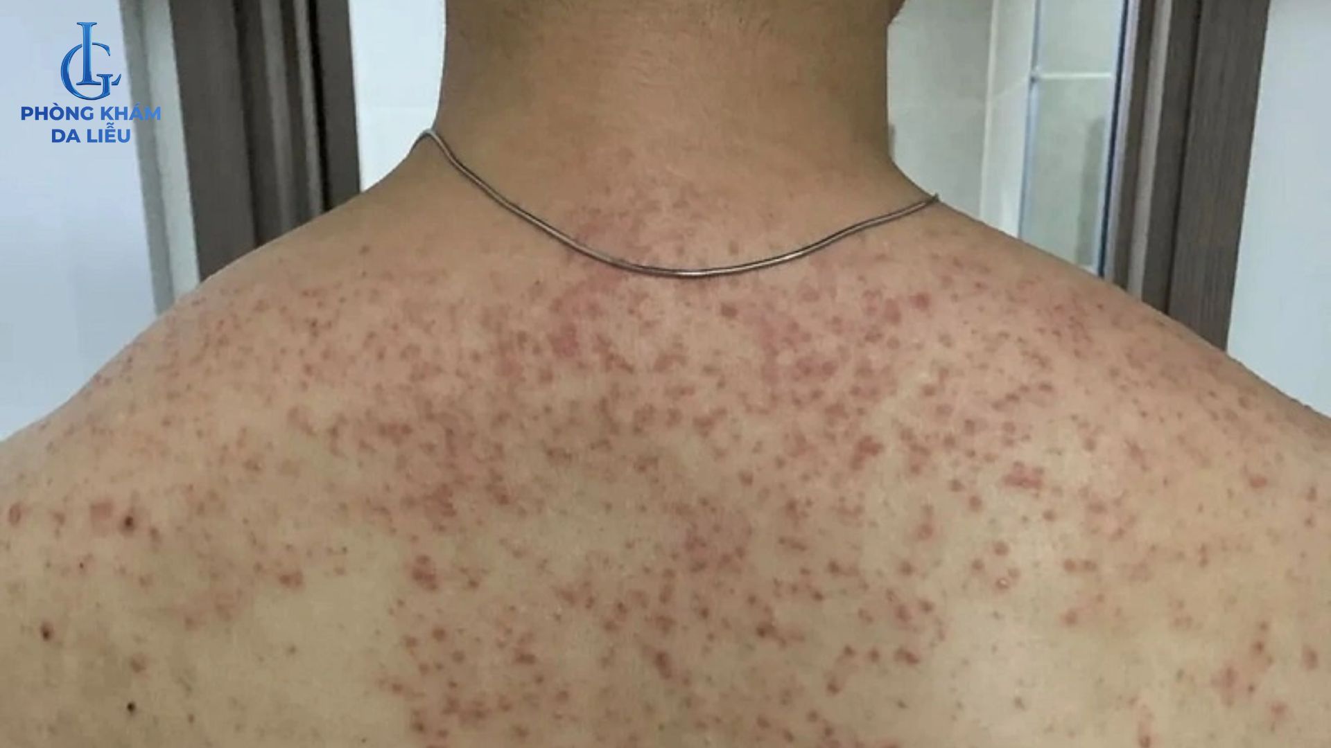 mụn lưng nghiêm trong trên da