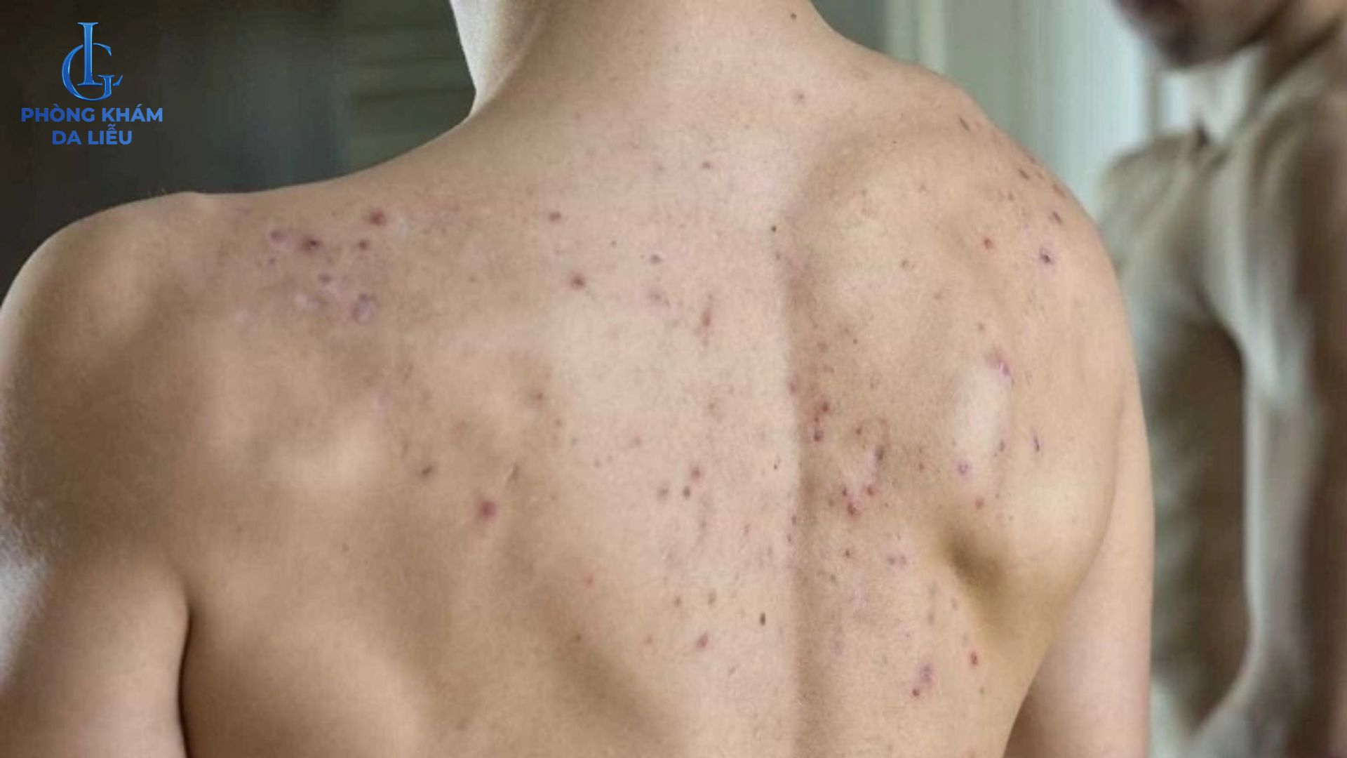 mụn lung ơ nam gioi