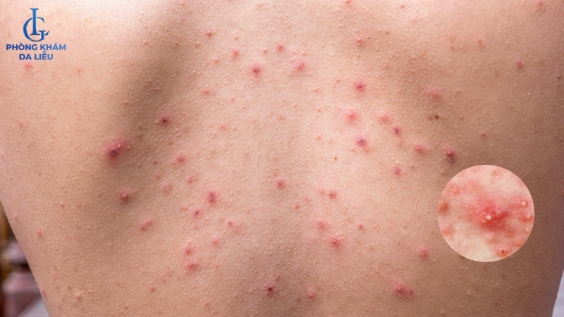 mụn mủ ở lưng nam giới