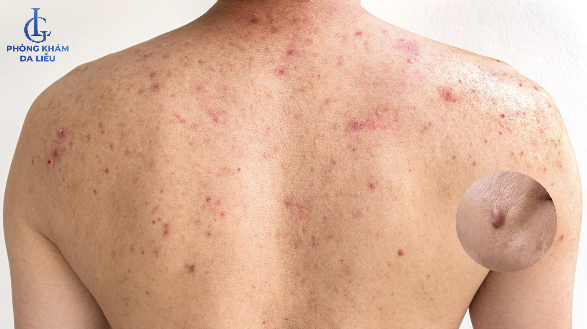 mụn nang vùng lưng nam