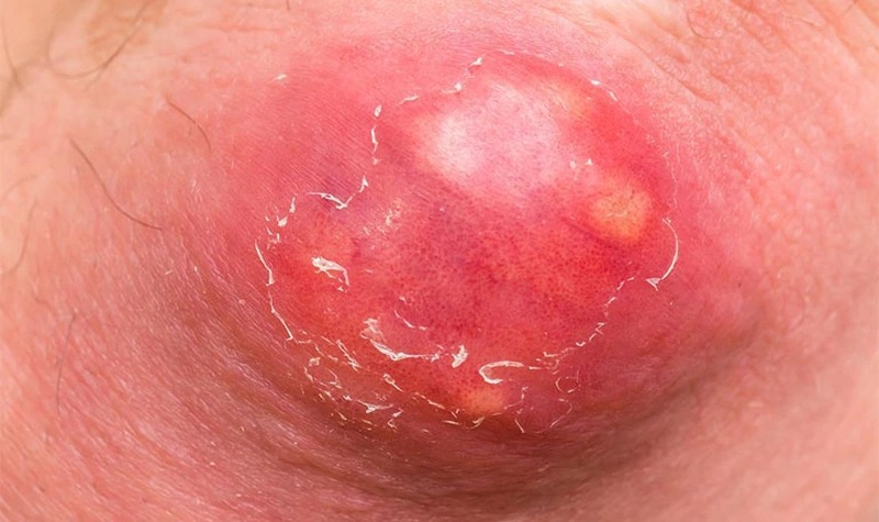 hình ảnh mụn nhọt