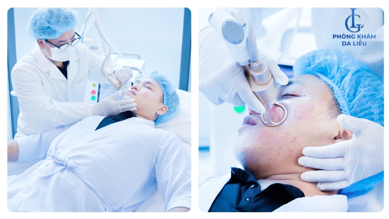 Laser CO2 Fractional trị mụn