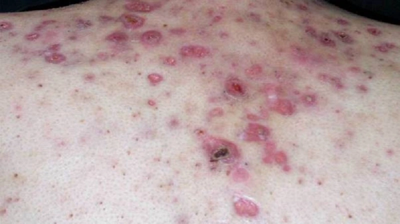 Mụn nhọt ở lưng viêm chứa mủ
