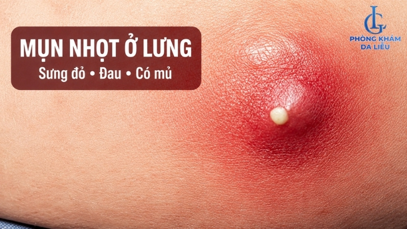 mụn nhọt ở lưng