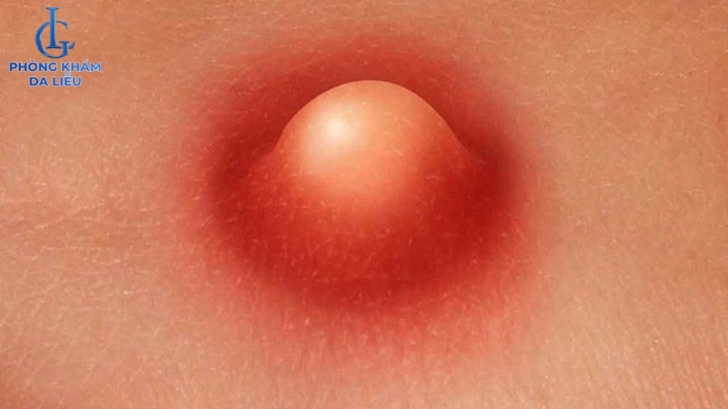 mụn nhọt ở lưng là gì