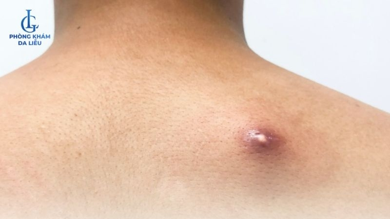 mụn nhọt ở vùng lưng