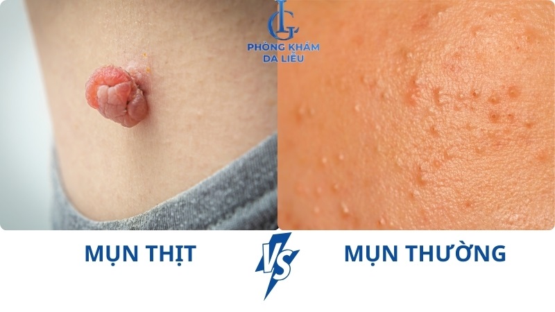 phân biệt mụn thịt với các loại mụn thông thường
