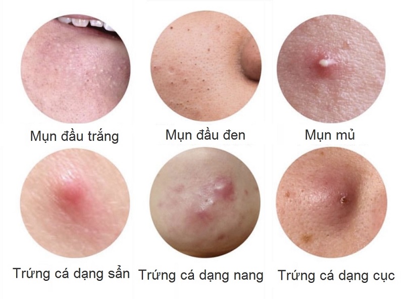 các loại mụn trứng cá