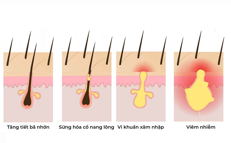 hình thành mụn trứng cá
