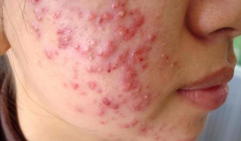 bị mụn trứng cá nặng