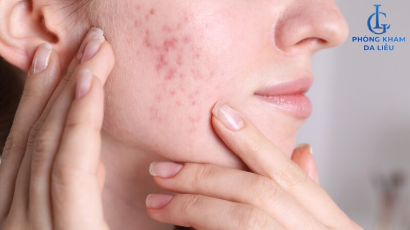 Mụn trứng cá có mủ