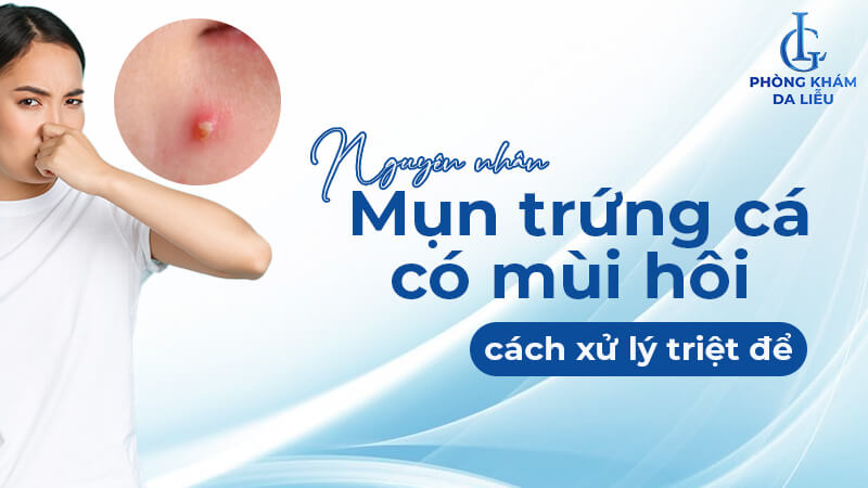 Mụn trứng cá có mùi hôi