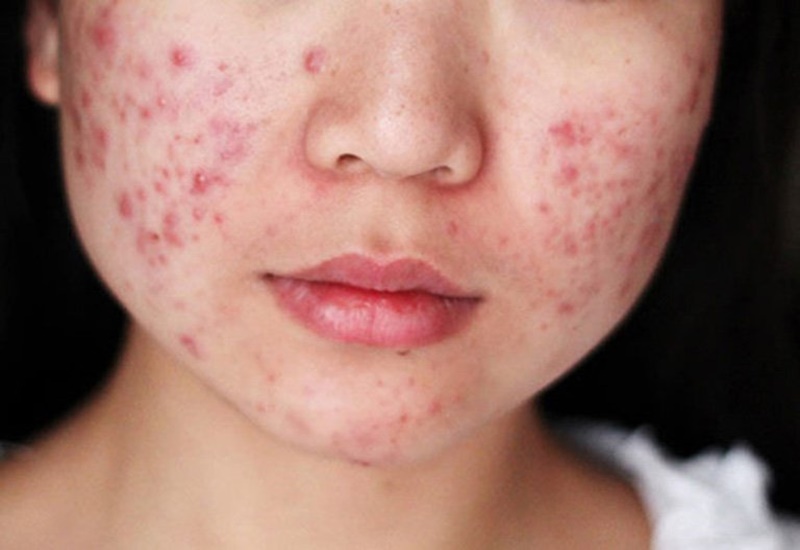 Mụn trứng cá ở mặt nhiều