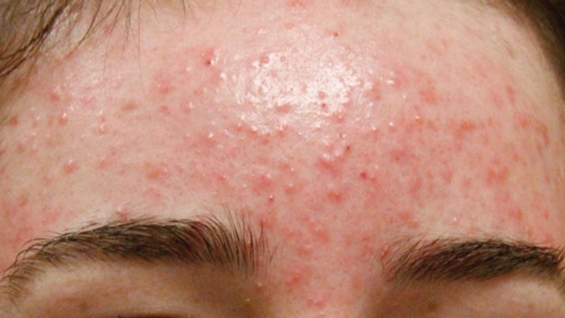 Mụn trứng cá đỏ ở trán