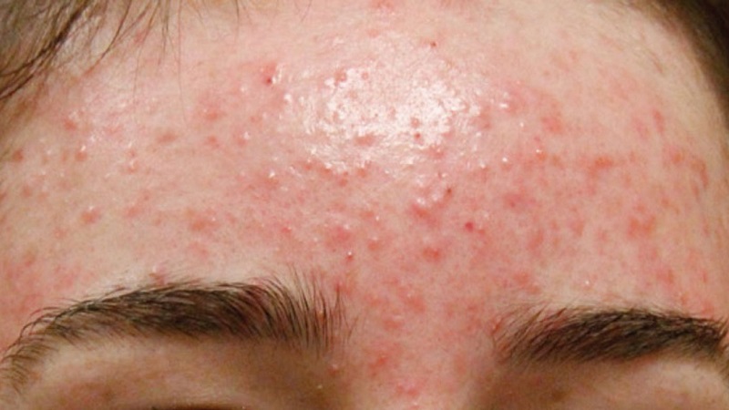 Mụn trứng cá đỏ thể sẩn - mủ