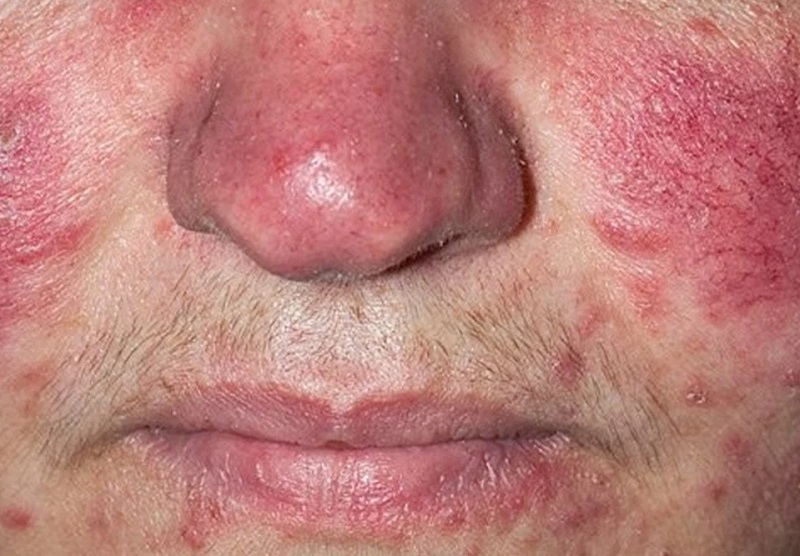 Mụn trứng cá đỏ thể phì đại
