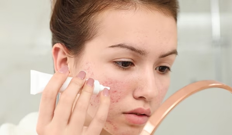 Sử dụng thuốc bôi ngoài da trị mụn
