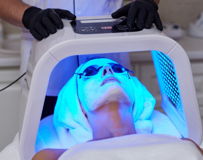 Liệu pháp laser và ánh sáng trị mụn trứng cá đỏ