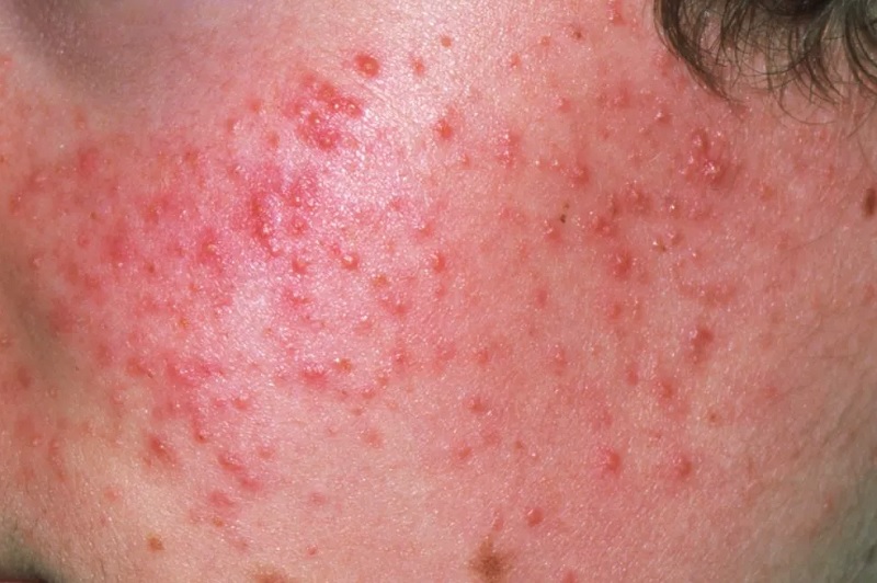 nguyên nhân gây mụn trứng cá đỏ