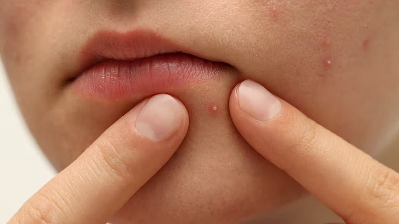 bị mụn trứng cá mủ ở mép miệng